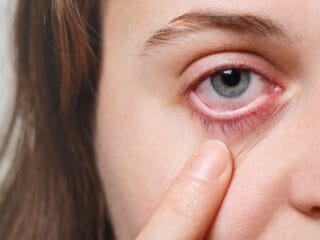 Mata Merah Tak Selalu Sepele, Kenali Gejala Konjungtivitis dan Kapan Harus ke Dokter