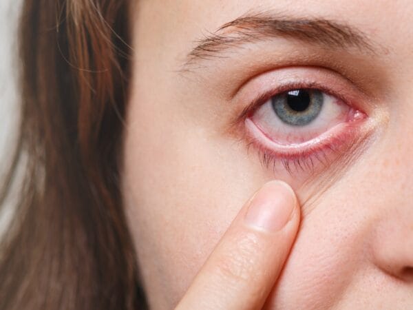Mata Merah Tak Selalu Sepele, Kenali Gejala Konjungtivitis dan Kapan Harus ke Dokter