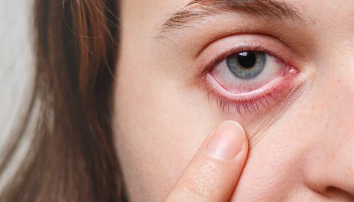 Mata merah tak selalu sepele. Kenali gejala konjungtivitis, penyebab, bahaya mengobati sendiri, dan kapan harus ke dokter.