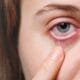 Mata merah tak selalu sepele. Kenali gejala konjungtivitis, penyebab, bahaya mengobati sendiri, dan kapan harus ke dokter.