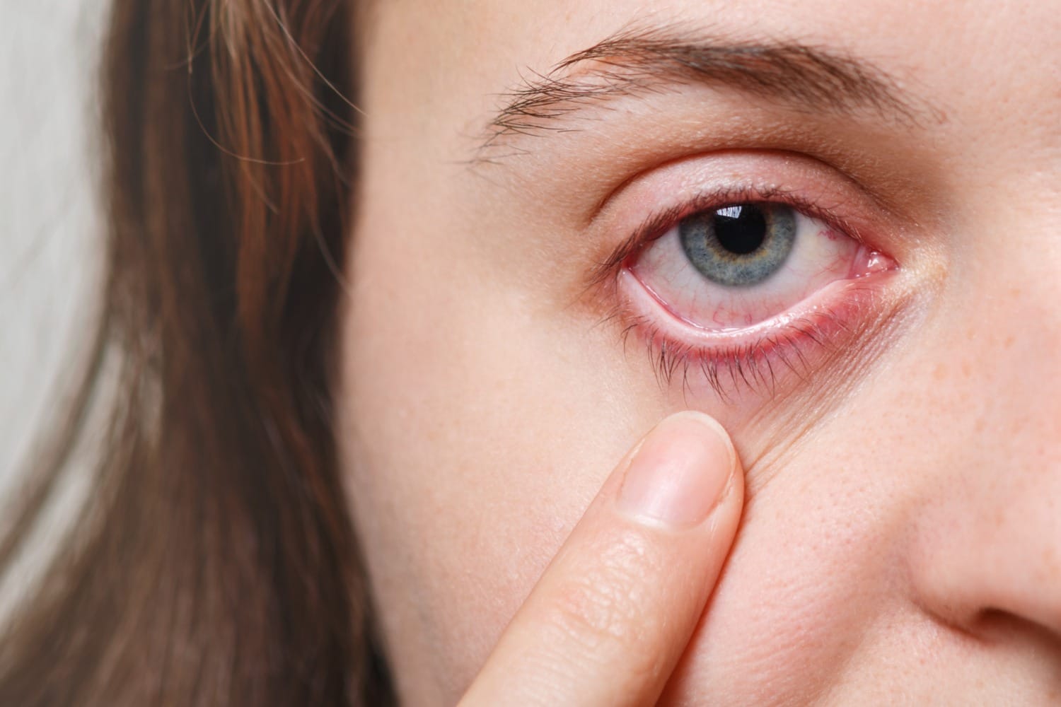 Mata merah tak selalu sepele. Kenali gejala konjungtivitis, penyebab, bahaya mengobati sendiri, dan kapan harus ke dokter.